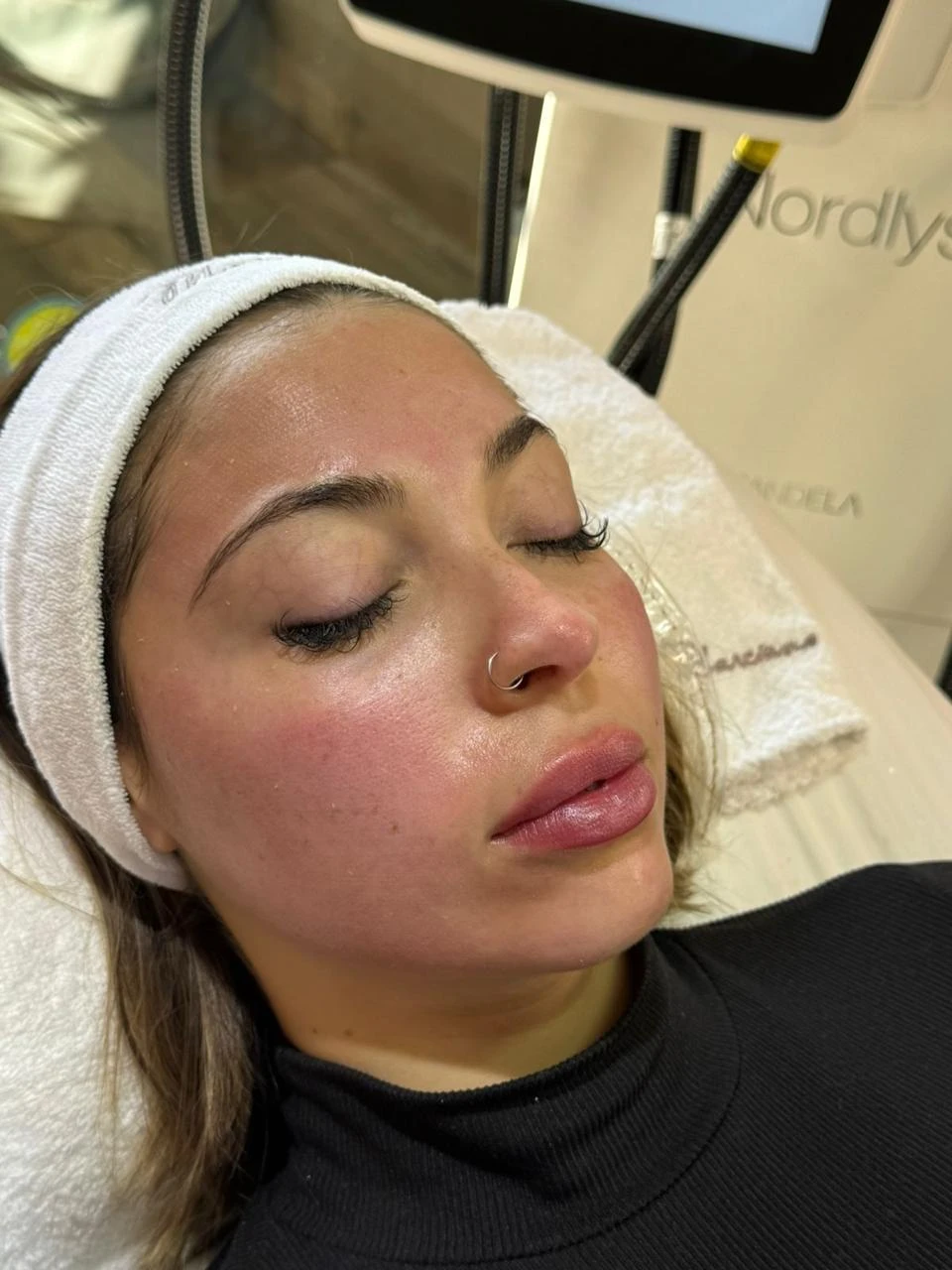 Tratamiento de labios SIN AGUJAS