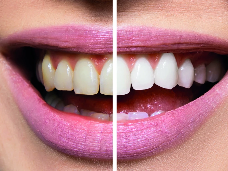 Blanqueamiento dental profesional