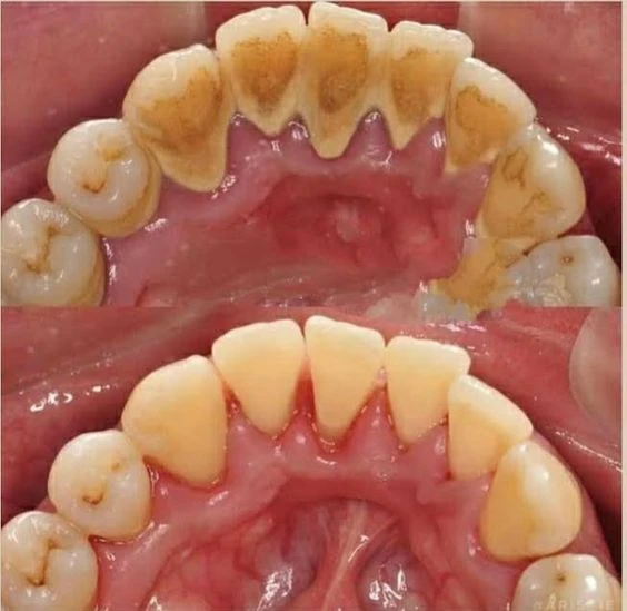 Limpieza dental con ultrasonido: todo lo que tenés que saber para cuidar tu sonrisa.