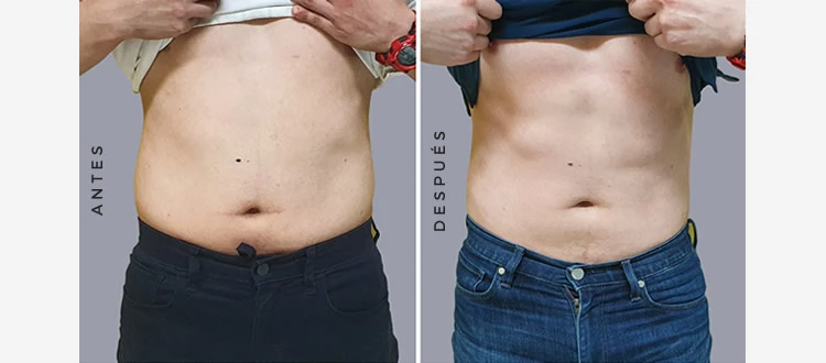 CM Slim Antes y Despues
