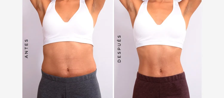 CM Slim Antes y Despues Mujer
