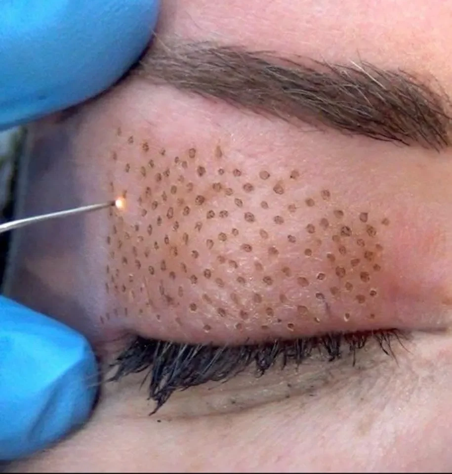 Blefaroplastia