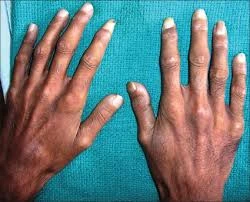 Nuevo tratamiento en investigación para Pseudo Xanthoma Elasticum (PXE)