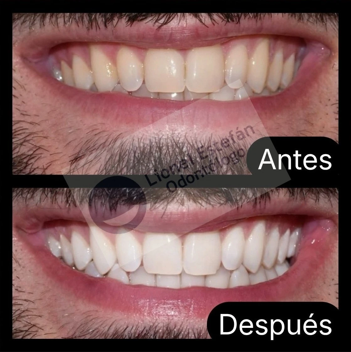 blanqueamientodental-(3927).webp