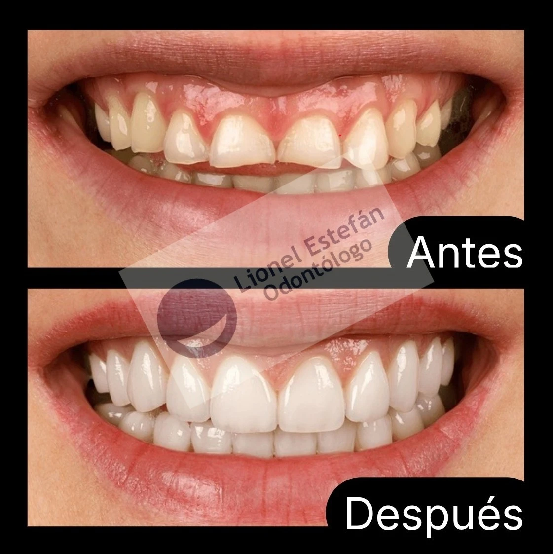 carillasdentales-(2198).webp