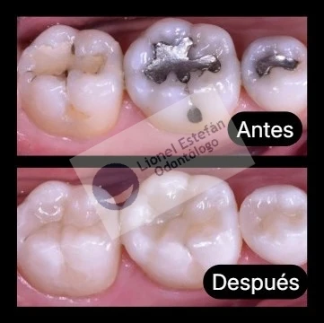 compositeporamalgama-(8298).webp