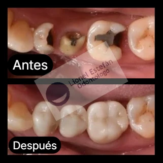 coronasdentales-(8654).webp