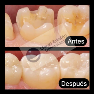 incrustaciones-(3360).webp