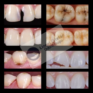 restauracionesdentales-(8610).webp
