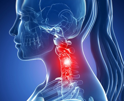 CERVICALGIA