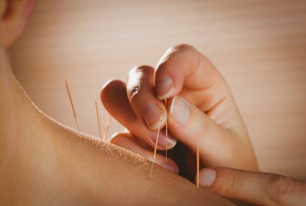 ACUPUNTURA