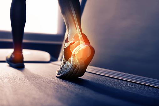 FASCITIS PLANTAR