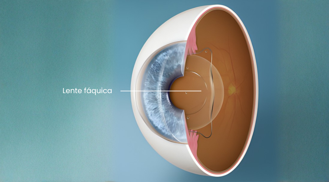 Cirugía facorefractiva, lente intraocular