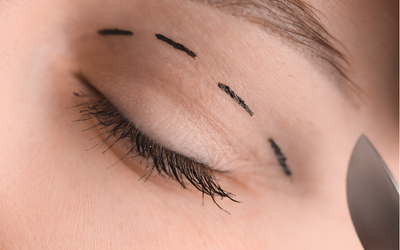 blefaroplastia