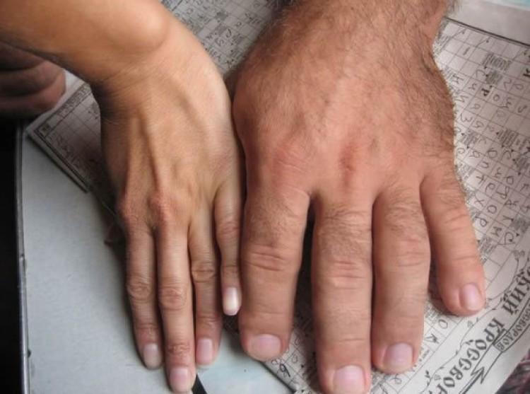 Acromegalia: cuando el espejo devuelve una fisonomía diferente (PRIMERA EDICION)