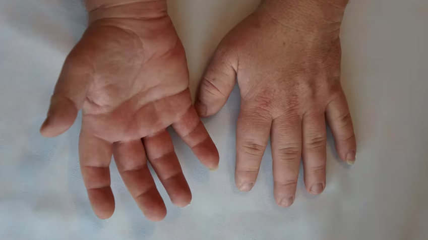 Qué es la acromegalia, la enfermedad poco frecuente que modifica los rasgos físicos y la fisonomía (INFOBAE)