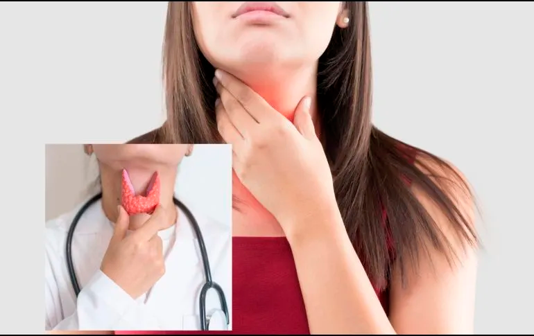 INFORMADOR - Día Mundial del Cáncer de Tiroides: Cómo prevenirlo y factores de riesgo