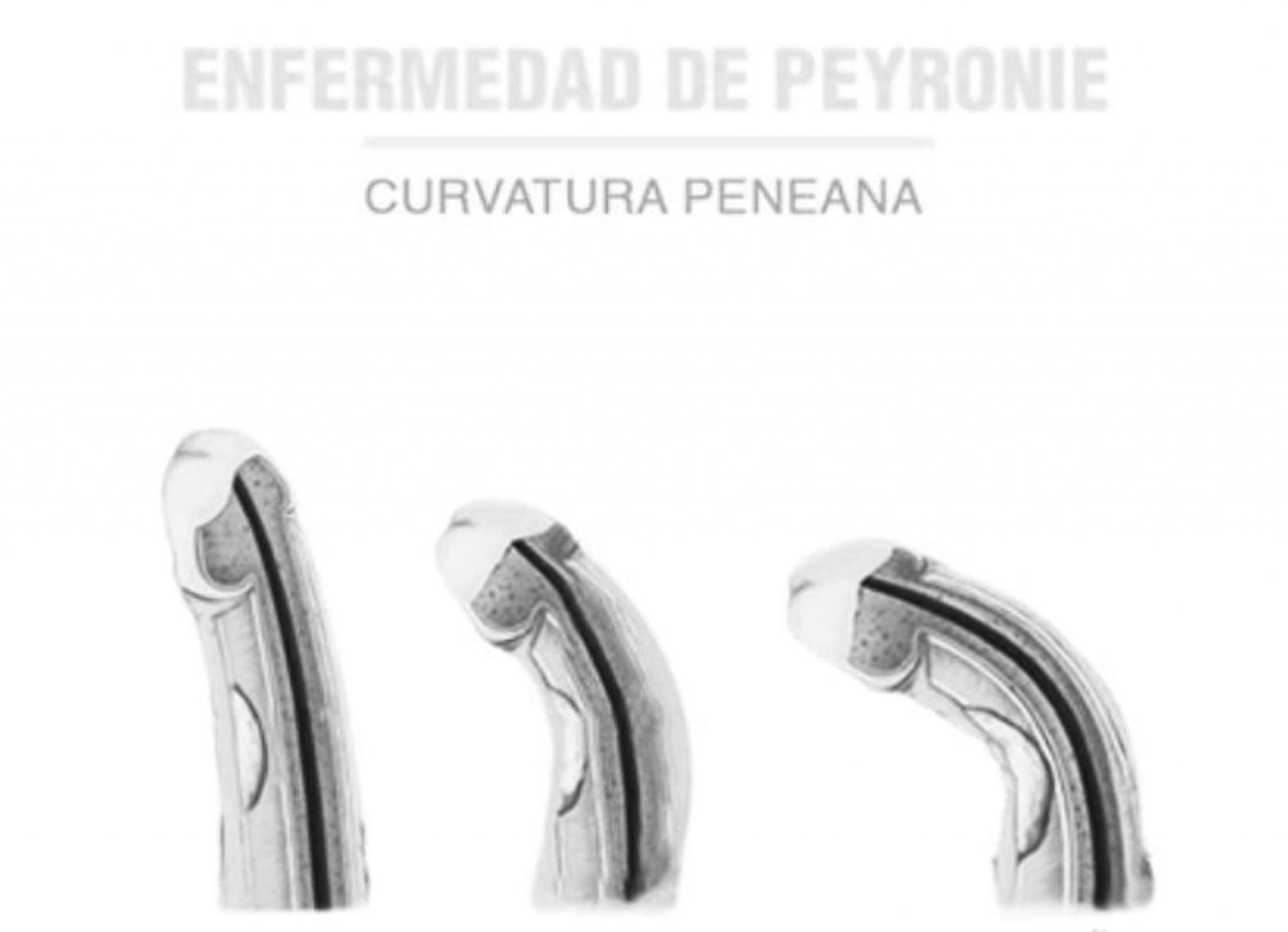 Enfermedad de Peyronie 