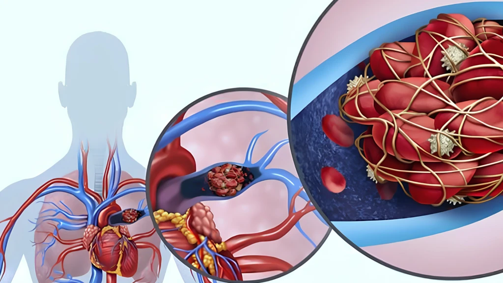Epidemiología de la embolia pulmonar: tendencias, factores de riesgo, comorbilidades e implicaciones clínicas.