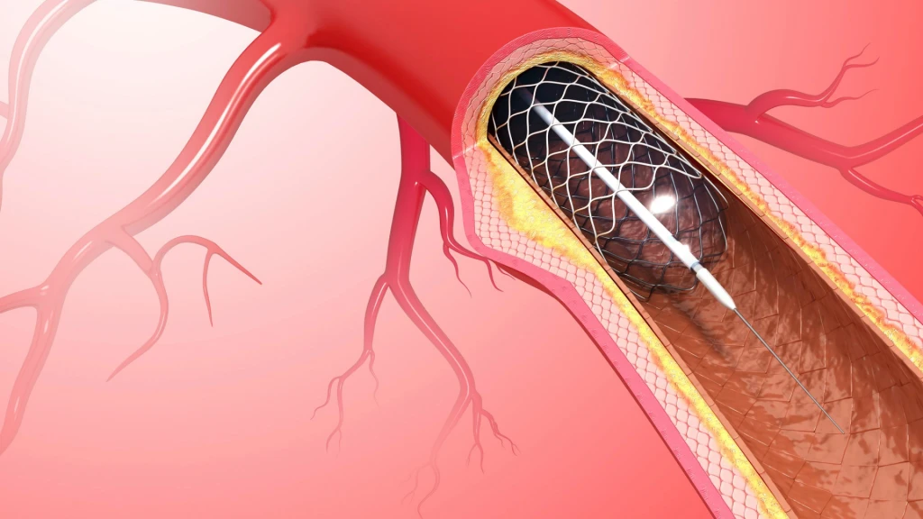 Intervención coronaria percutánea vs bypass coronario para la estenosis del tronco principal izquierdo no protegido.