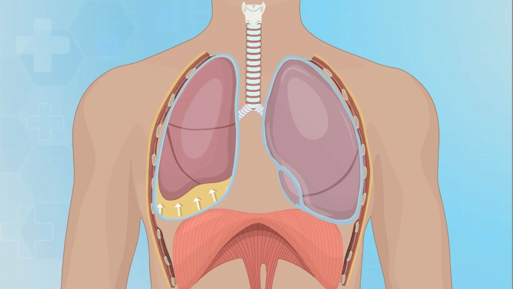 Secuenciación del líquido pleural y el plasma para la pleuritis tuberculosa.