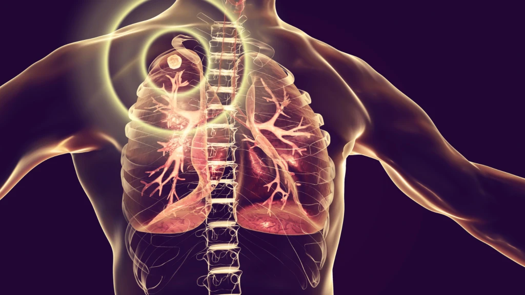 Resultados del tratamiento y supervivencia a largo plazo sin recaídas tras tuberculosis multirresistente.