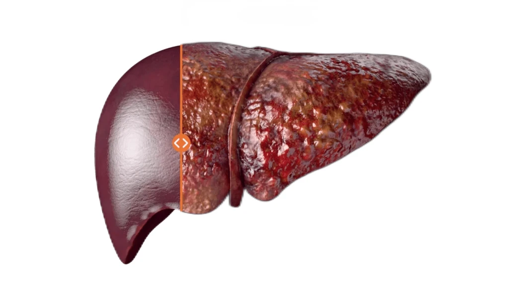 Prevalencia de fibrosis hepática en la población general.