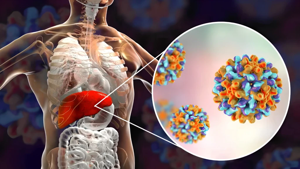 Resultados de la fase 3 del tratamiento con bepirovirsen para la infección crónica por el virus de la hepatitis B.