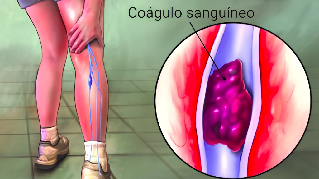 Tromboembolia venosa tras sujeción mecánica en hospitales psiquiátricos.