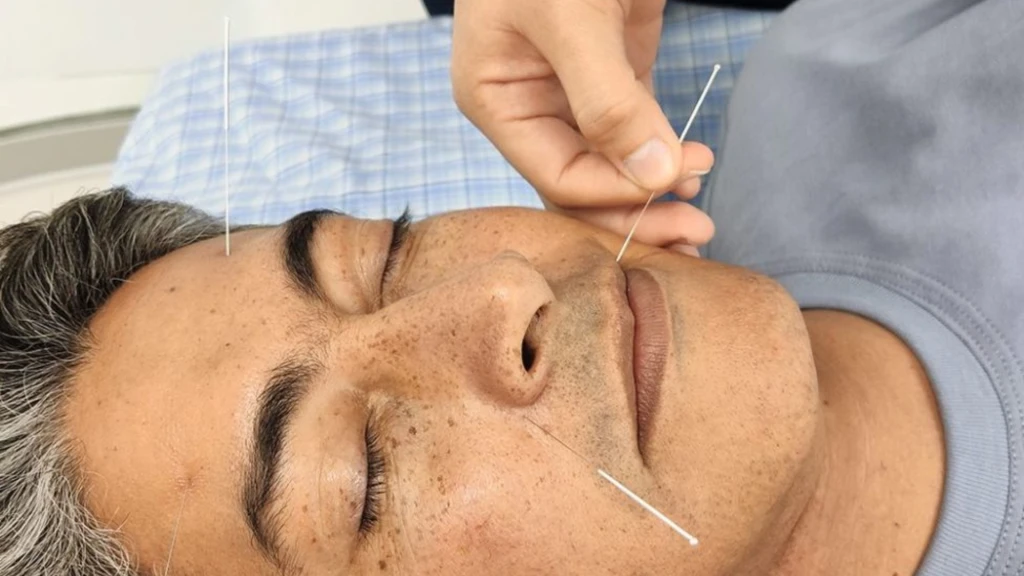 Evidencia actualizada sobre la acupuntura para la neuralgia del trigémino: una revisión sistemática y metaanálisis con evaluación GRADE.