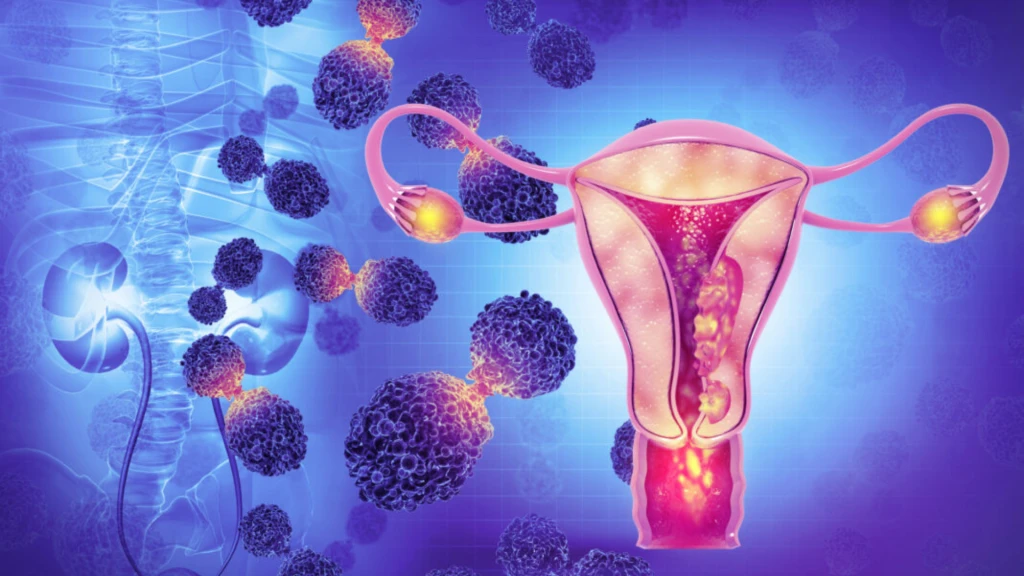 Cáncer de endometrio.