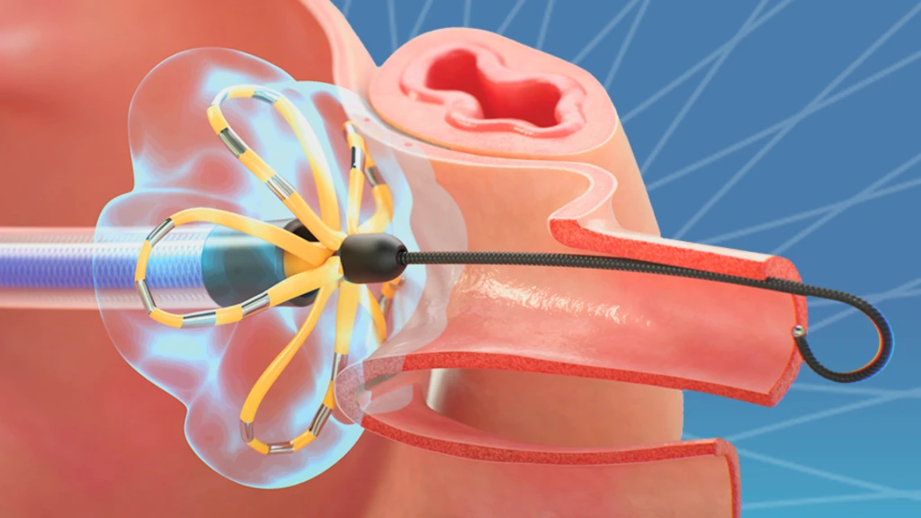 Ablación por campo pulsado como terapia inicial para la fibrilación auricular persistente.