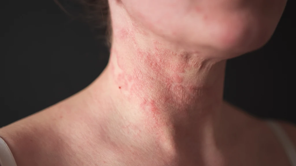Guías de atención para el manejo de la dermatitis atópica en pacientes pediátricos.