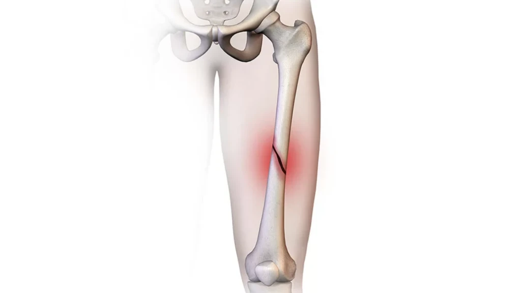 Fractura por fragilidad, fractura femoral atípica y osteonecrosis mandibular tras la prescripción de bisfosfonatos durante tres y cinco años, según datos de atención primaria y secundaria en Inglaterra .