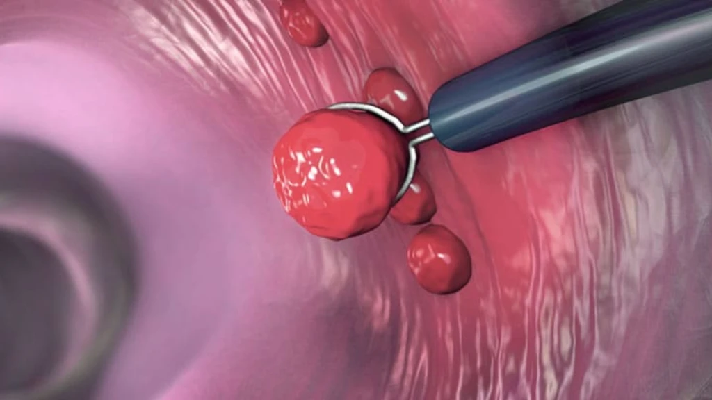 Efectos a largo plazo del cribado mediante colonoscopia sobre la incidencia y la mortalidad por cáncer colorrectal.