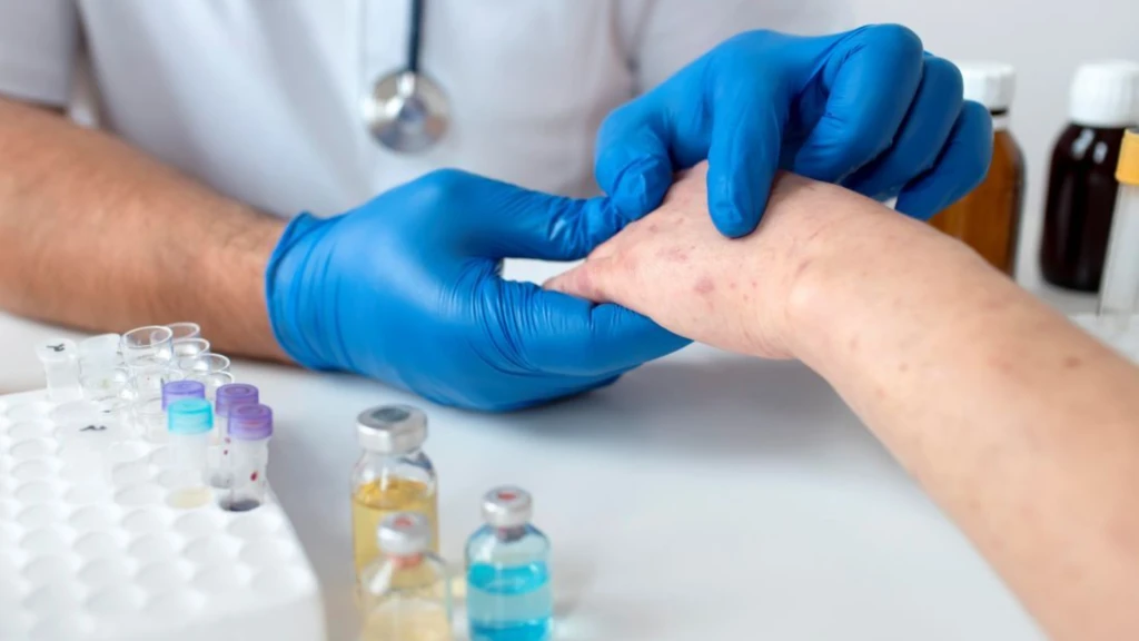 Combinación de ivermectina oral y crema de permetrina al 5% para tratar la sarna severa.