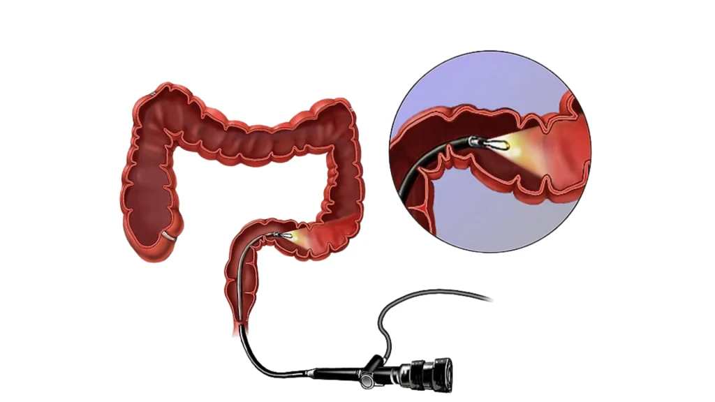 Beneficios de la sigmoidoscopia para el rastreo de cáncer colorrectal: seguimiento a 23 años.