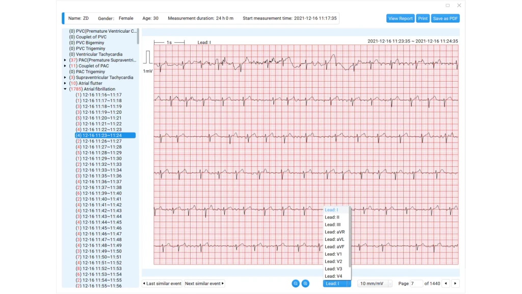 Electrocardiograma con inteligencia artificial para rastreo de la disfunción sistólica del ventrículo izquierdo.
