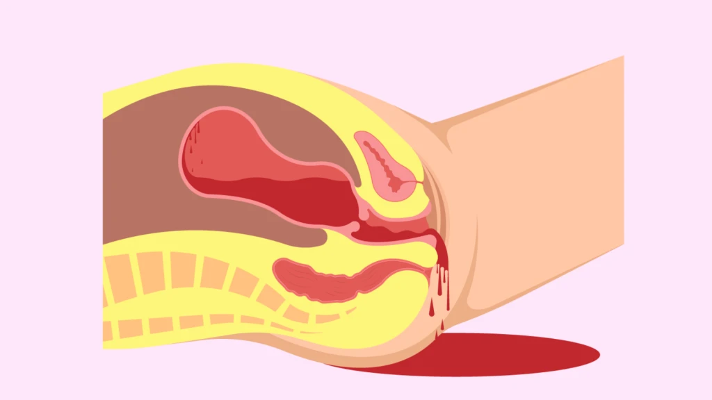 Ácido tranexámico profiláctico para la prevención de la hemorragia posparto en mujeres con placenta previa.