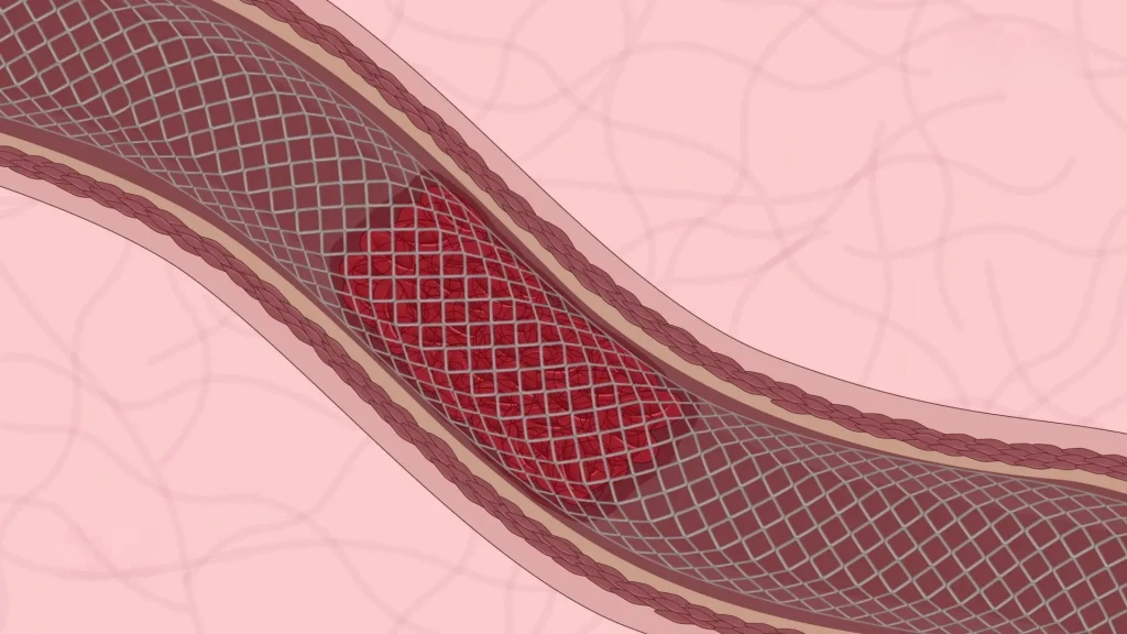Tratamiento endovascular de accidentes cerebrovasculares por oclusión de vasos medianos.
