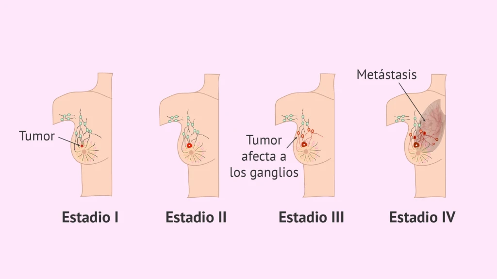 Incidencia y supervivencia del cáncer de mama en estadio IV, 2010-2021.